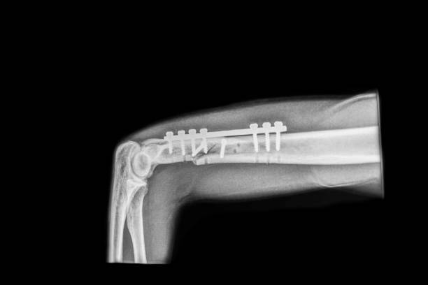 Fracture Repair (Internal Fixation)