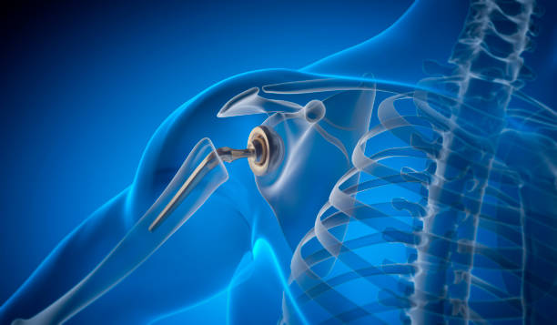 Rotator Cuff Repair