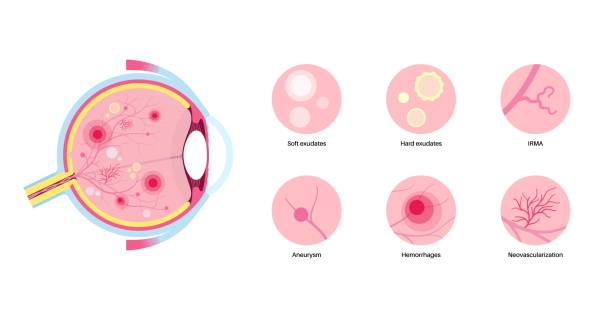 Retinal Detachment Repair