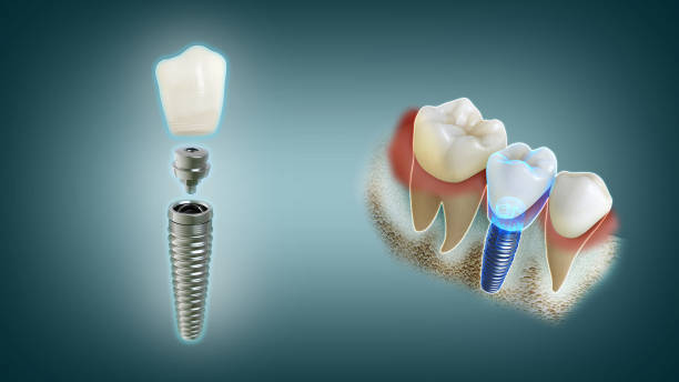 Dental Implants