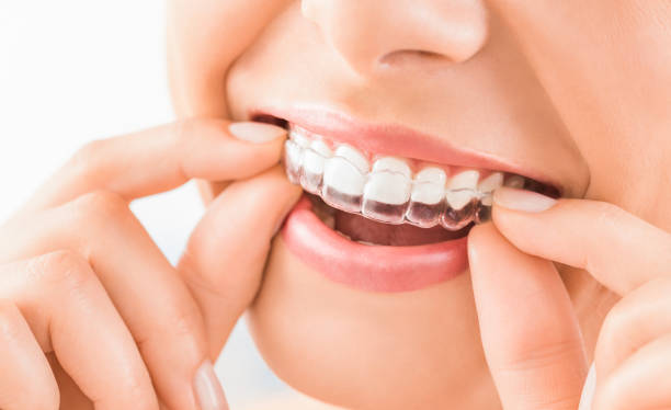 Braces and Aligners (Orthodontics)